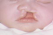 Cleft Lip
